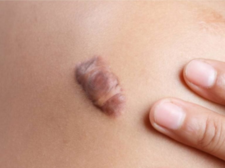Improvements of keloid scar