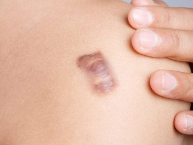 Improvements of keloid scar