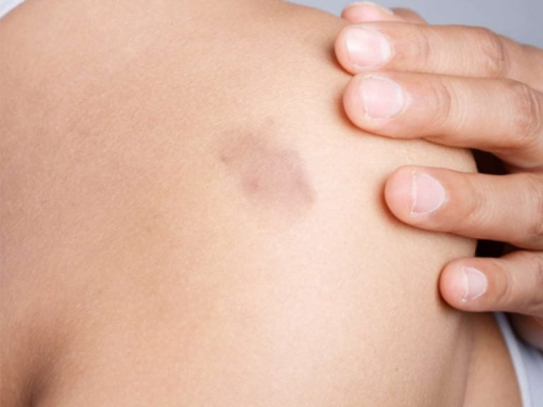 Improvements of keloid scar