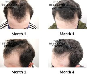 Elix alert-male-pattern-hair-loss-the-belgravia-centre-425554-300x266 Blogs 