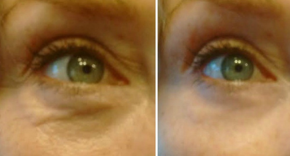 Before and After picture of under eyes